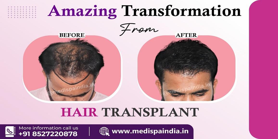 How To Choose The Best Hair Transplant Surgeon To Cure Hair Loss Issue?