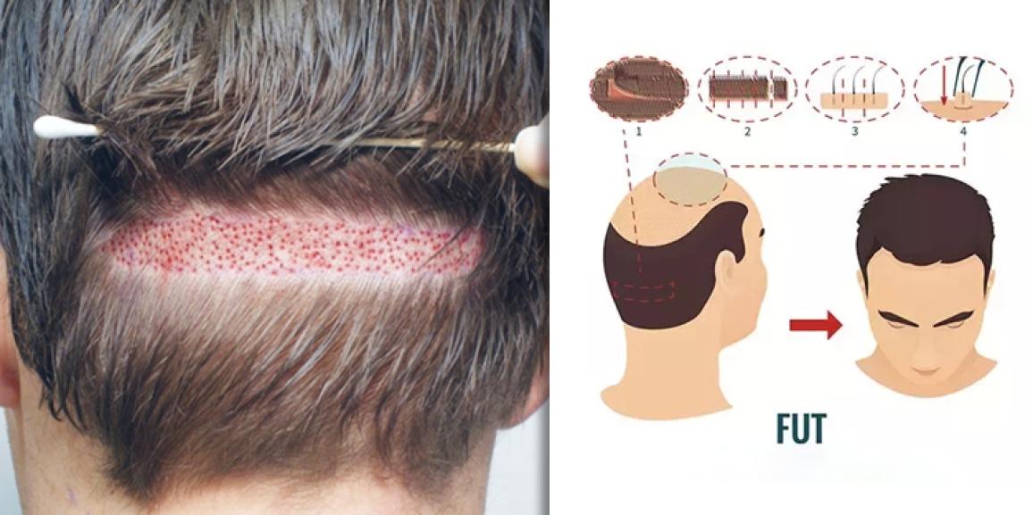 Explain The Importance Of FUT Method For Hair Transplant