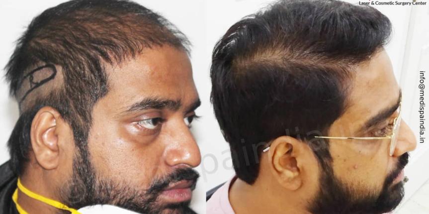 hair transplant cost in pune