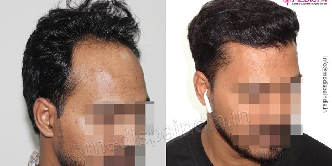 Can Hair Transplant Deliver The Long Lasting Outcomes?