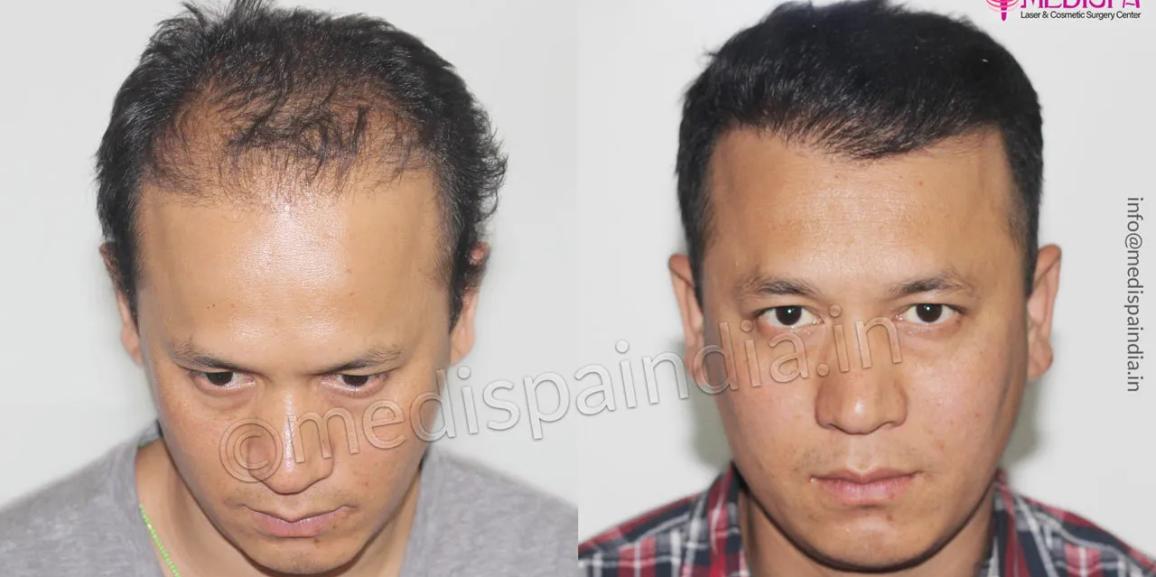 Should I Undergo Second Hair Transplant After The Unsuccessful Surgery?