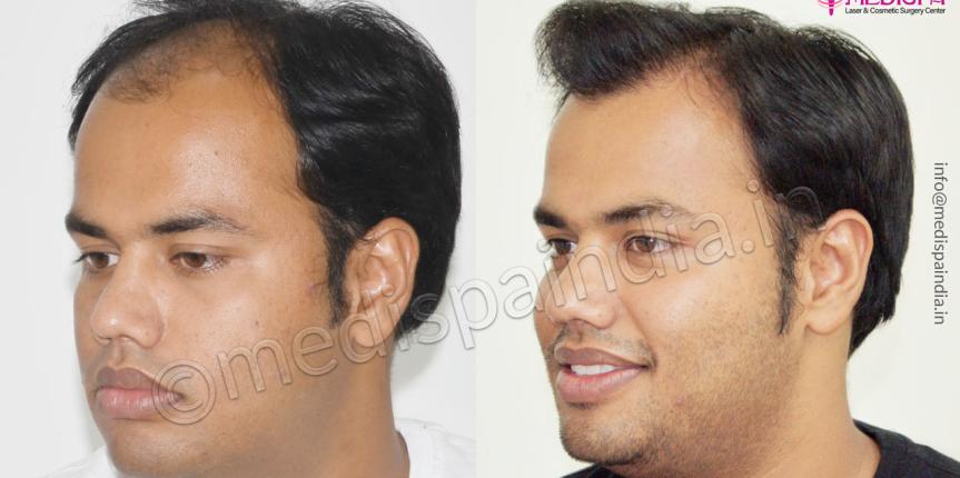 hair transplant cost in bikaner rajasthan