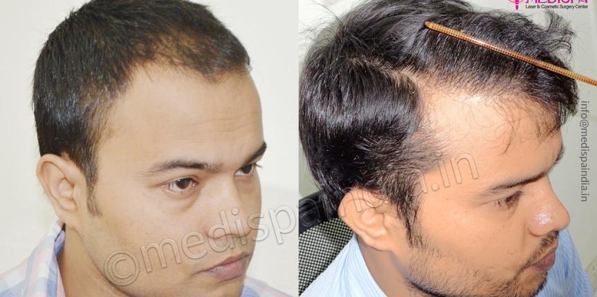 male hair transplant results jaipur