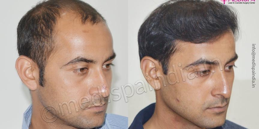 top hair transplant clinics in india