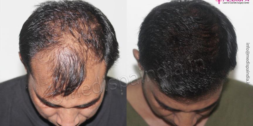 hair transplant before after delhi india