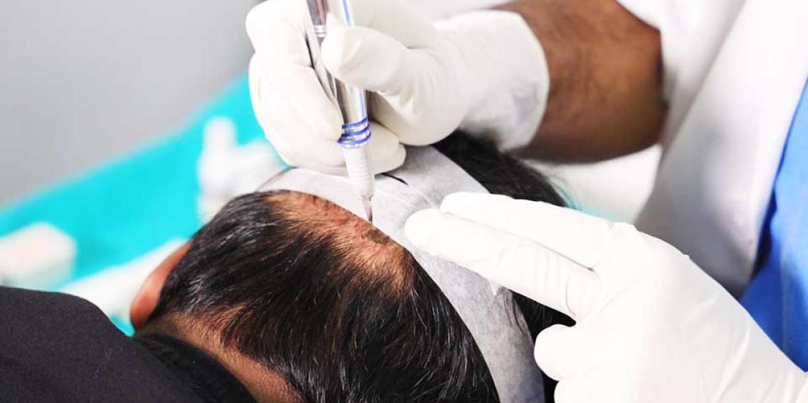 What Are The Common Myths And Facts About Hair Transplant?