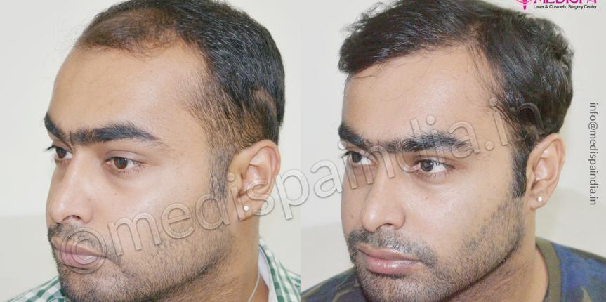 hair transplant cost in indore