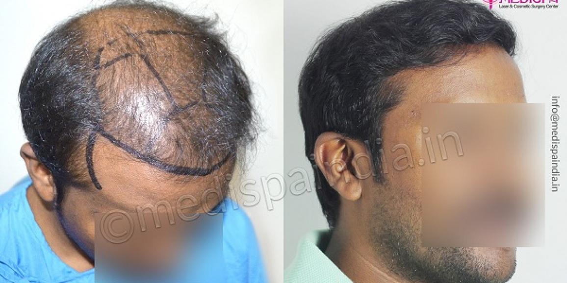 Explain The Hair Transplant Process From Start To End