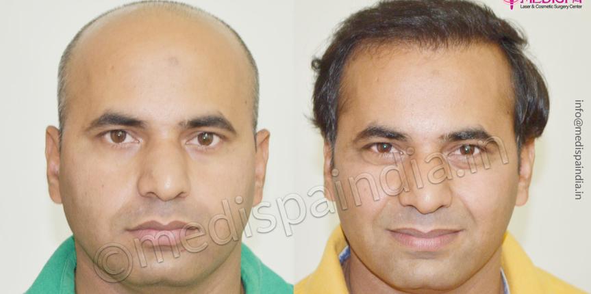 hair transplant in rajasthan