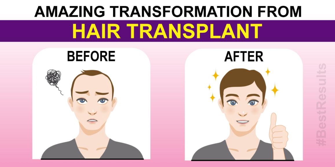 Say Good Bye To Hair Loss and Get a New Look With Hair Transplant