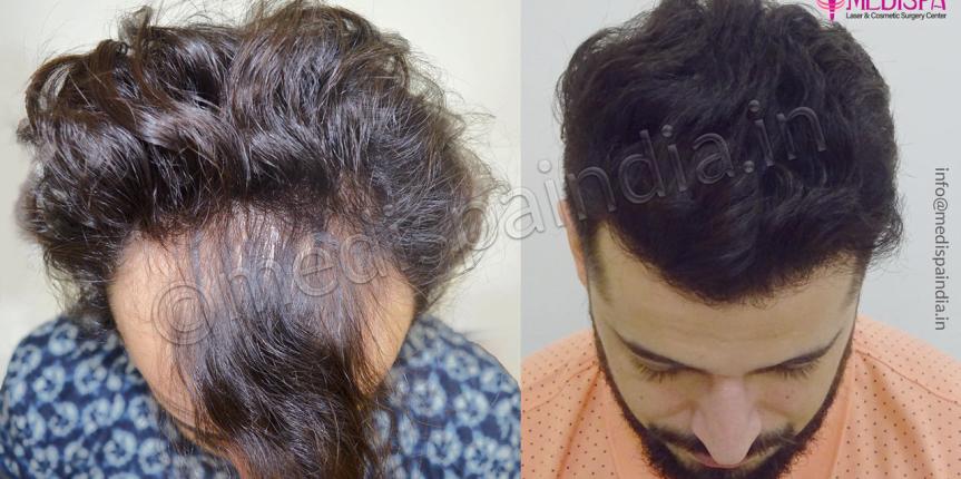 hair transplant in united states of america