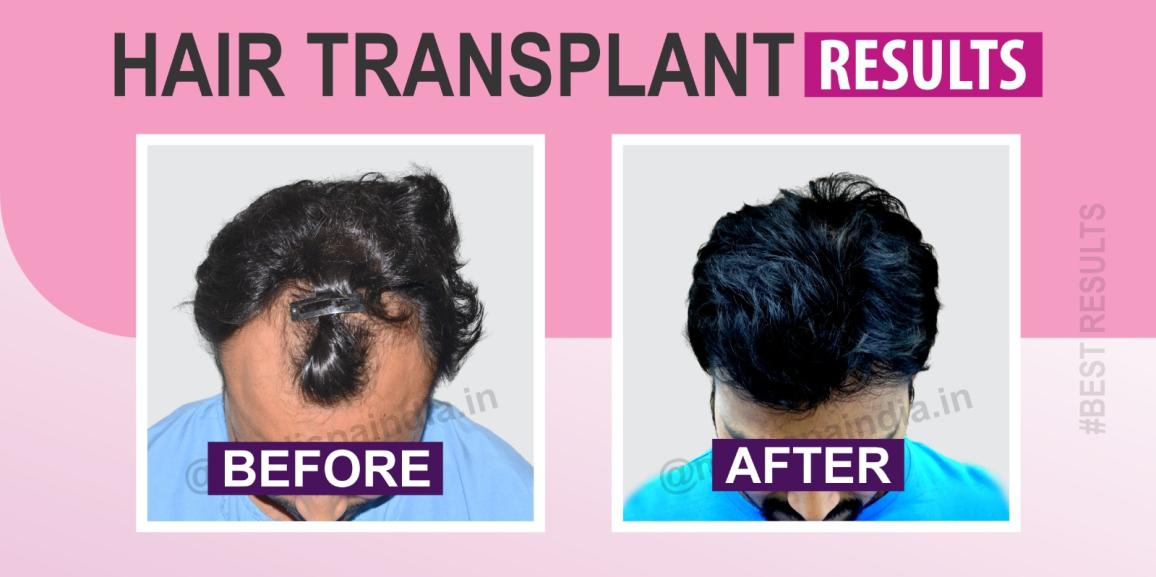What Are The Various Hair Transplant Options And Their Significance?