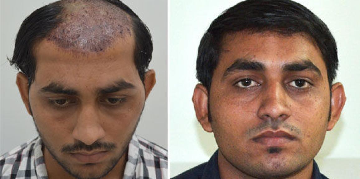 Understanding Hair Transplantation: The Procedure, Costs, And Risks