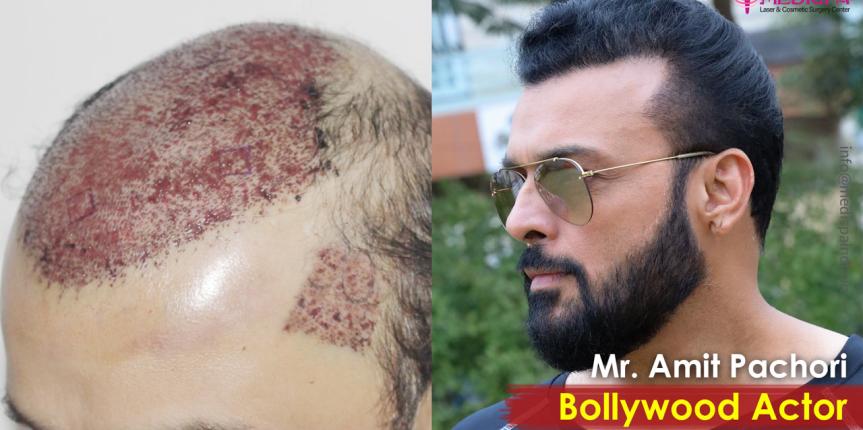 Actor Amit Pachori Hair Transplant Results