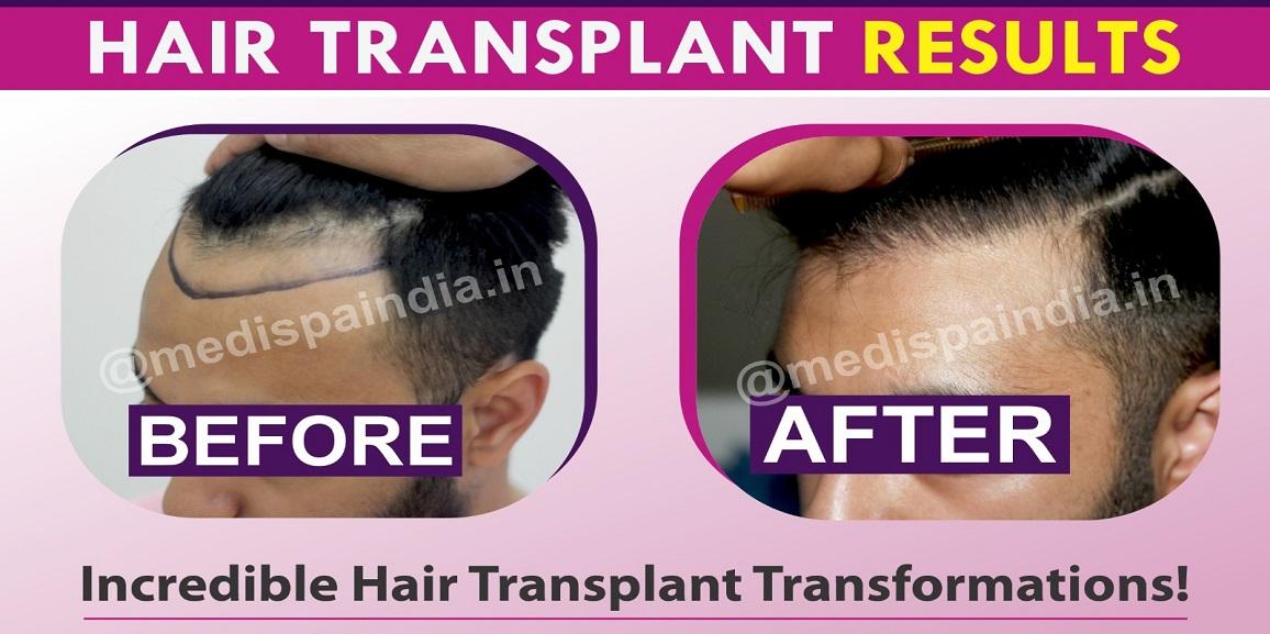 Why Should You Choose An Experienced Surgeon For Hair Transplant?