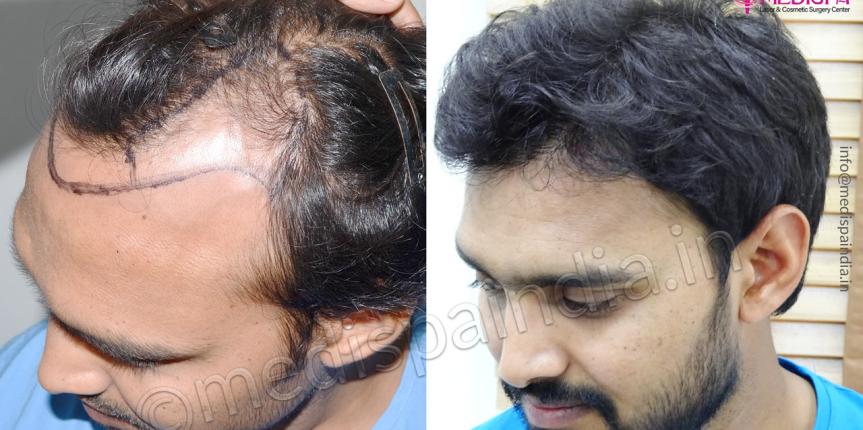 top hair transplant clinics in pune