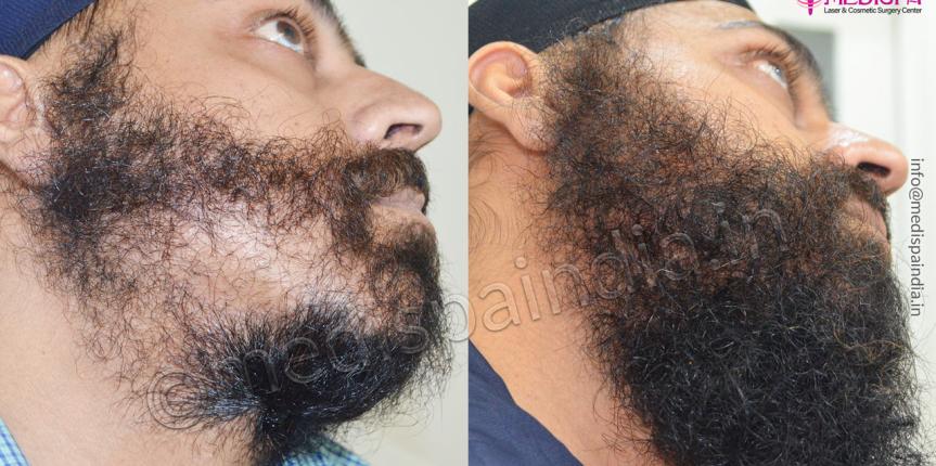 beard hair transplant india