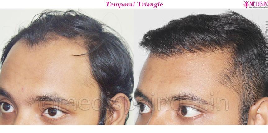 fue hair transplant cost india
