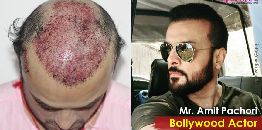 celebrity hair transplant india
