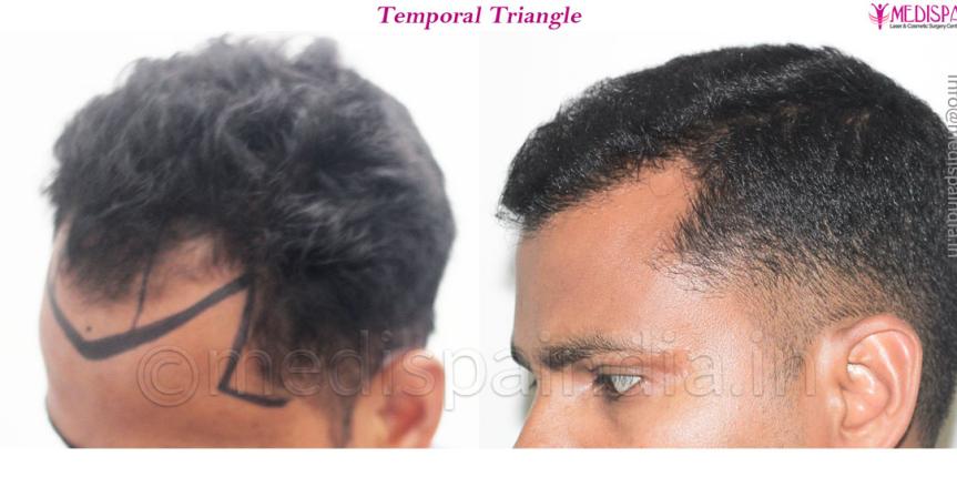 hair transplant rajathan results 8 months