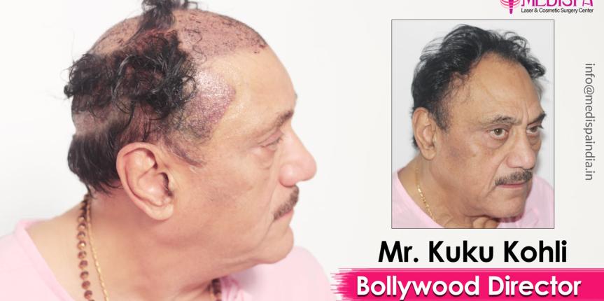 bollywood actor hair transplant results