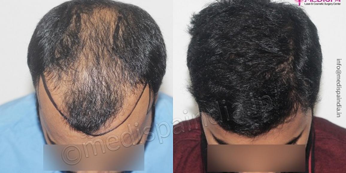 Things To Know About Male Hair Transplant