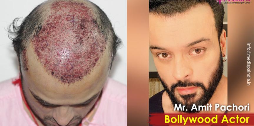bollywood actor hair transplant india