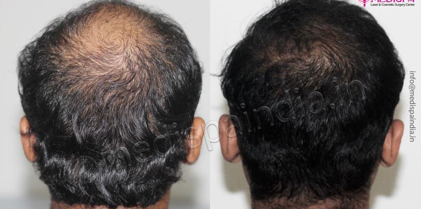 hair transplant cost delhi