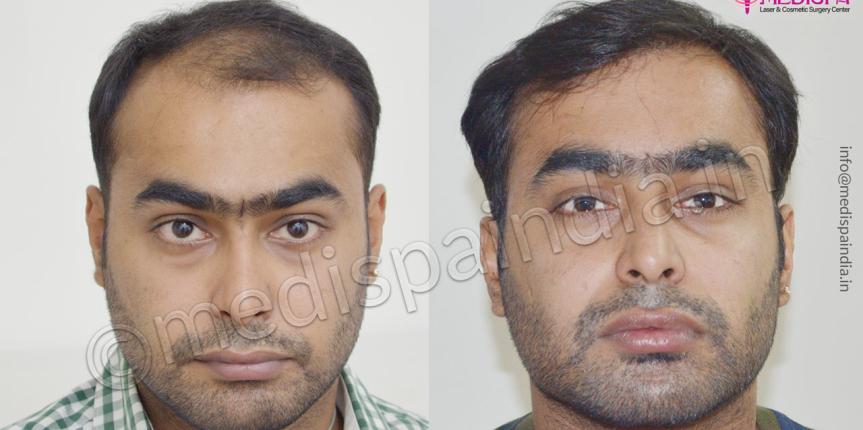 hair transplant in indore