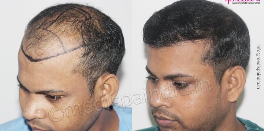 hair restoration delhi india