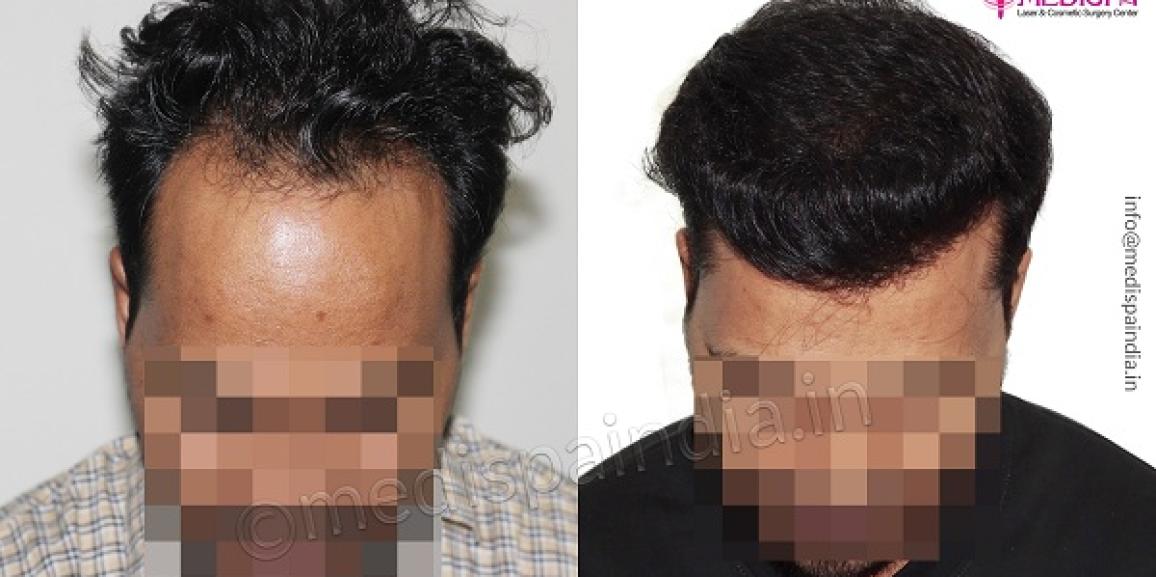 How To Improve Graft Survival Rate In Hair Transplantation?