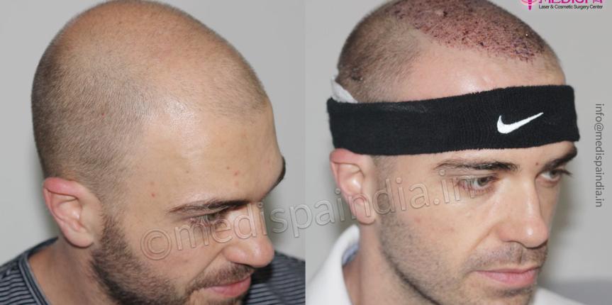 hair transplant abroad results