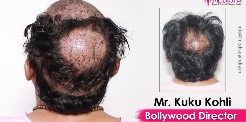 celebrity hair transplant delhi