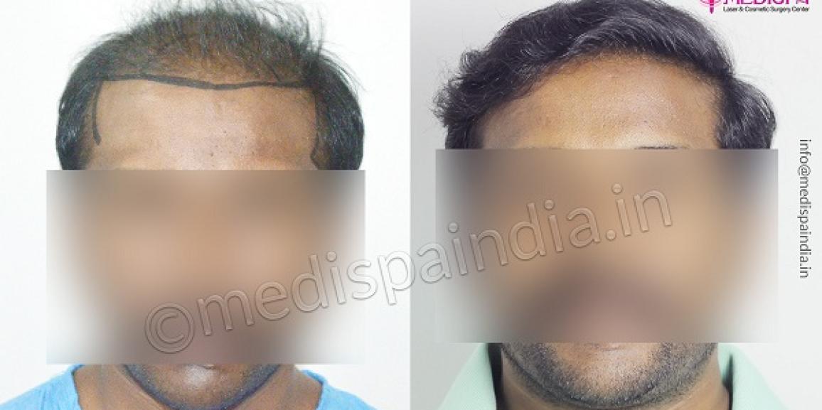 What Are The Advantages of FUT+FUE Combination Method of Hair Transplant?