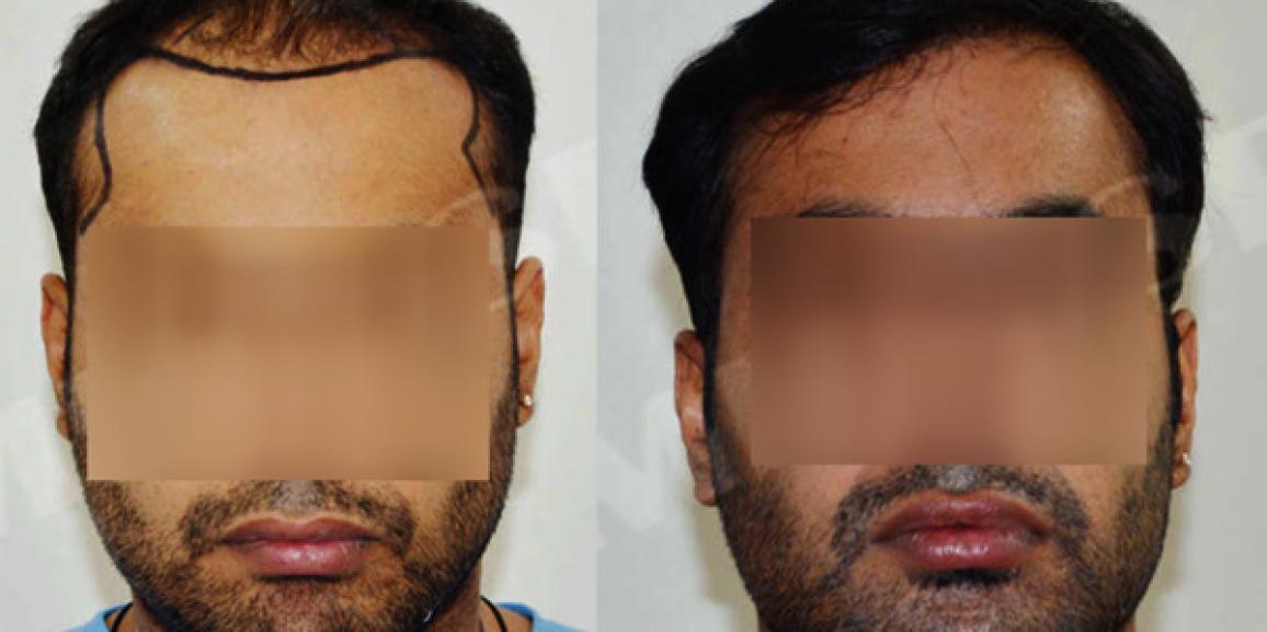 How To Know About The Number of Grafts Required For Hair Transplant Surgery?