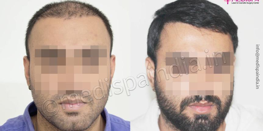 hair transplant cost in canada