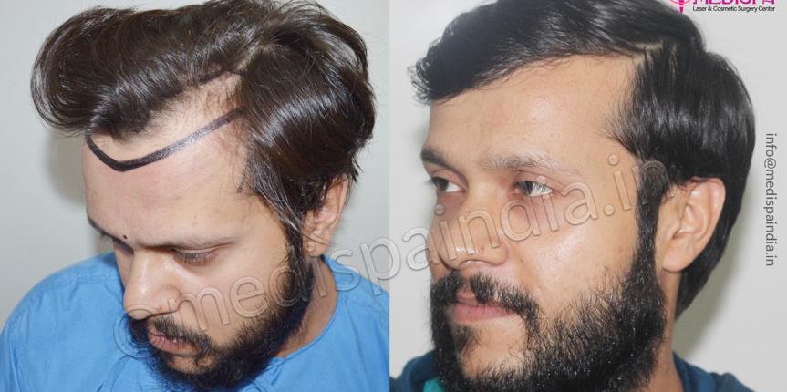 hair transplant surgeons in chandigarh india