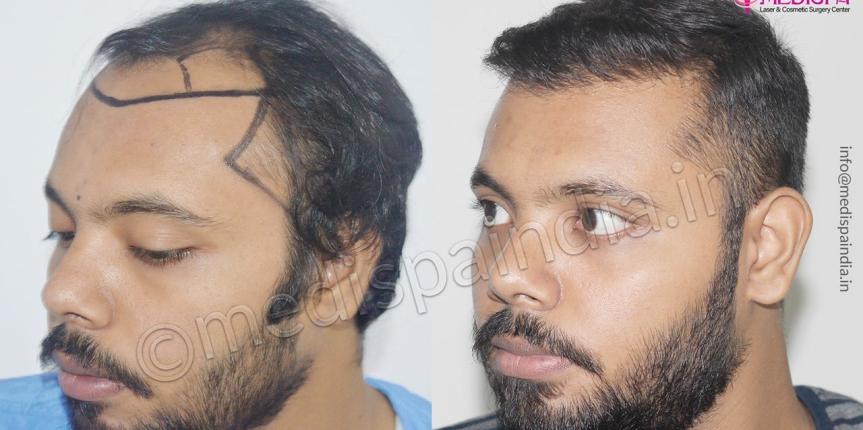 fue hair transplant before after