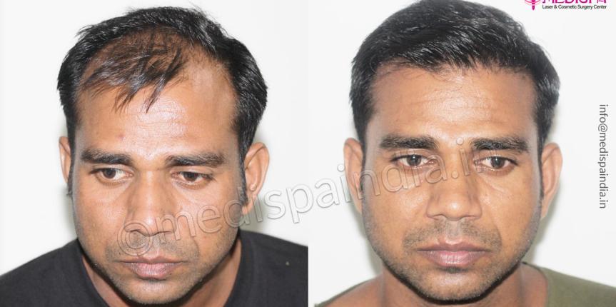 hair restoration before after india hair restoration before after india