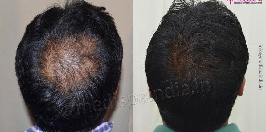 crown hair transplant results