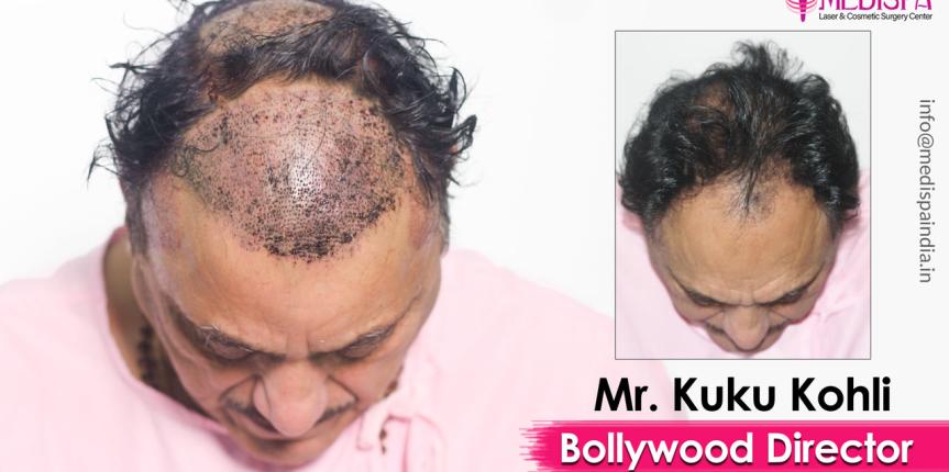 best celebrity hair transplant surgeon india