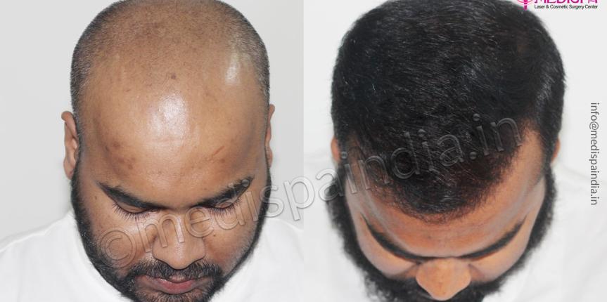 hair restoration results delhi