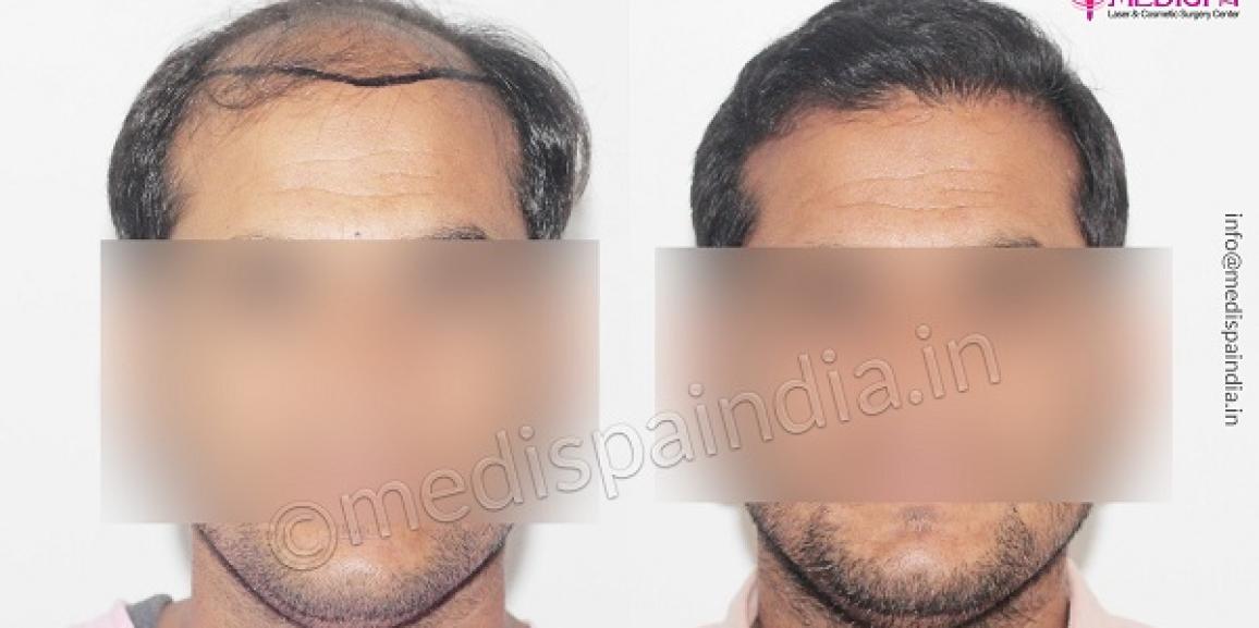 A Comprehensive Guide To Hair Transplant For Hair Loss Issue