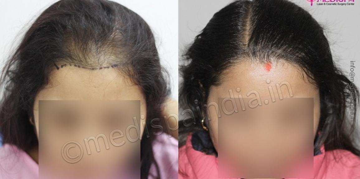From Balding To Beautiful: The Success of Hair Transplant Surgery