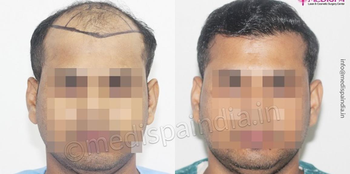 Is Hair Transplant The Most Effective Treatment For Alopecia Areata?