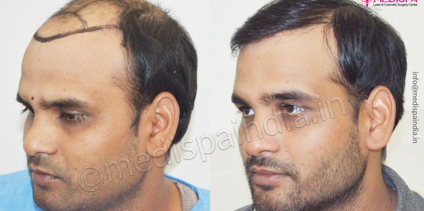 hair transplant cost in ahmedabad