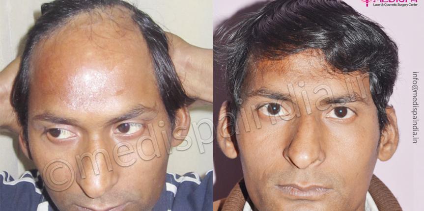 burn hair transplant repair rajasthan