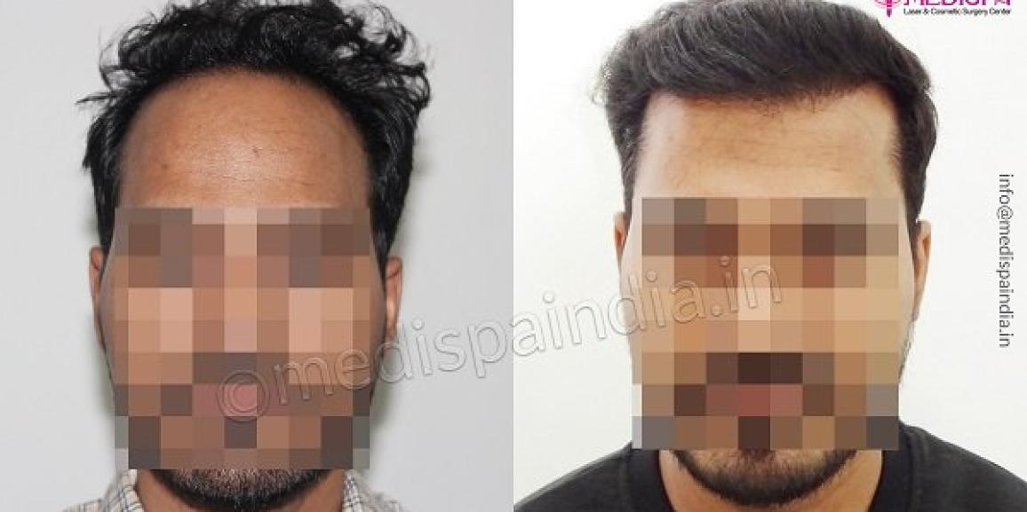 Is Hair Transplant Better Than Prosthetic Hair?