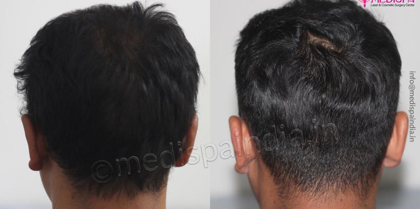 hair-transplant-results-rajatshan-jaipur