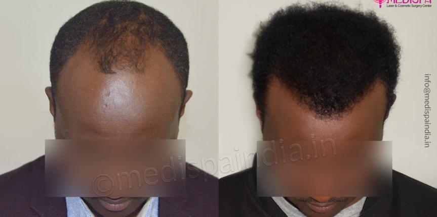 africans hair transplant results